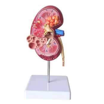 Bojājumi Nieru Modeli Cilvēka Anatomija Orgānu Medicīnas Mācību Materiāli